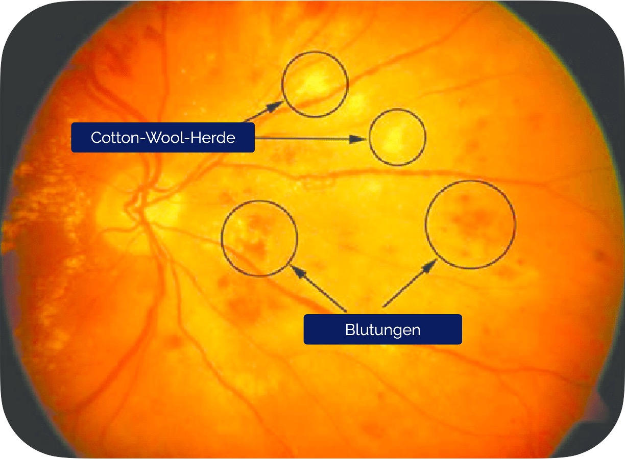 Nicht-proliferative diabetische Retinopathie