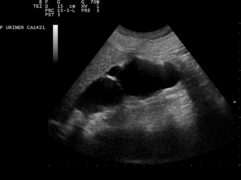 Hydronephrose Grad 4