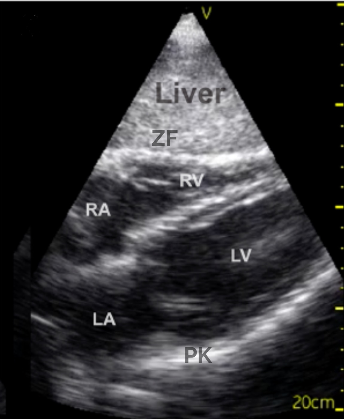 Normalbefund des Herzens in der subxiphoidalen Ansicht