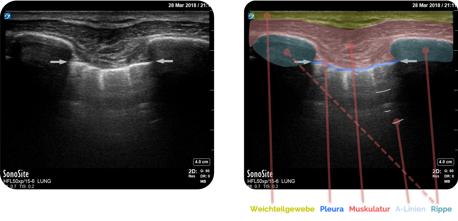 Normalbefund der Pleura im B-Mode