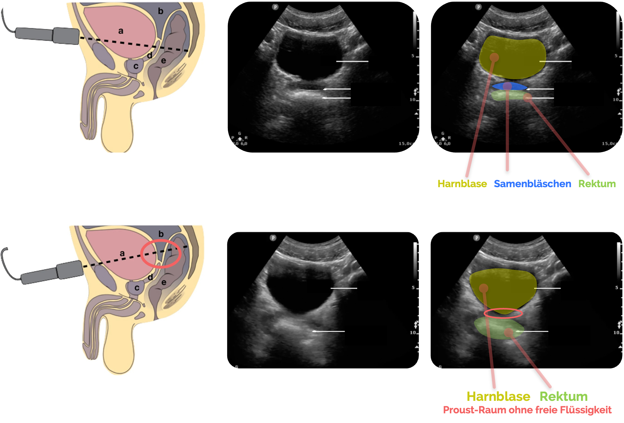 Normalbefund beim Mann: im Bild oben sind die Samenbläschen angeschnitten, im Bild unten ist der Proust-Raum angeschnitten
