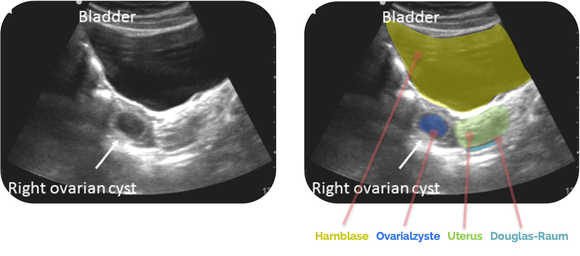Keine freie Flüssigkeit hinter dem Uterus