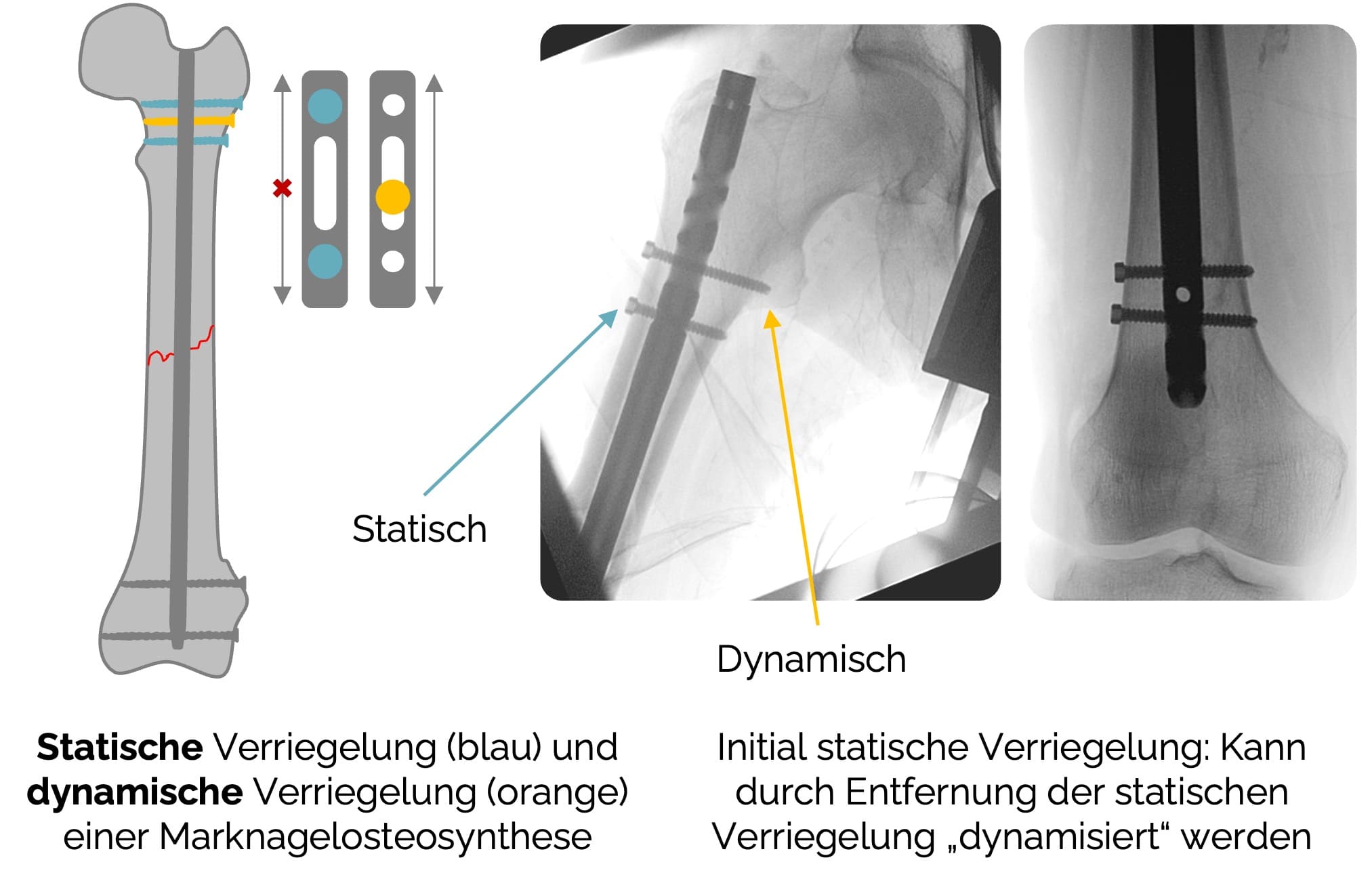 Operative Therapie bei Femurschaftfrakturen