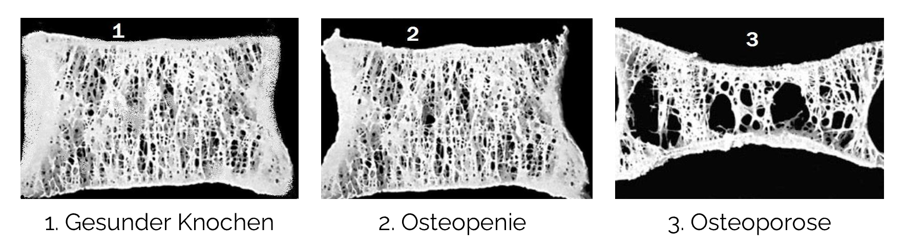 Pathologische Veränderungen bei Osteoporose