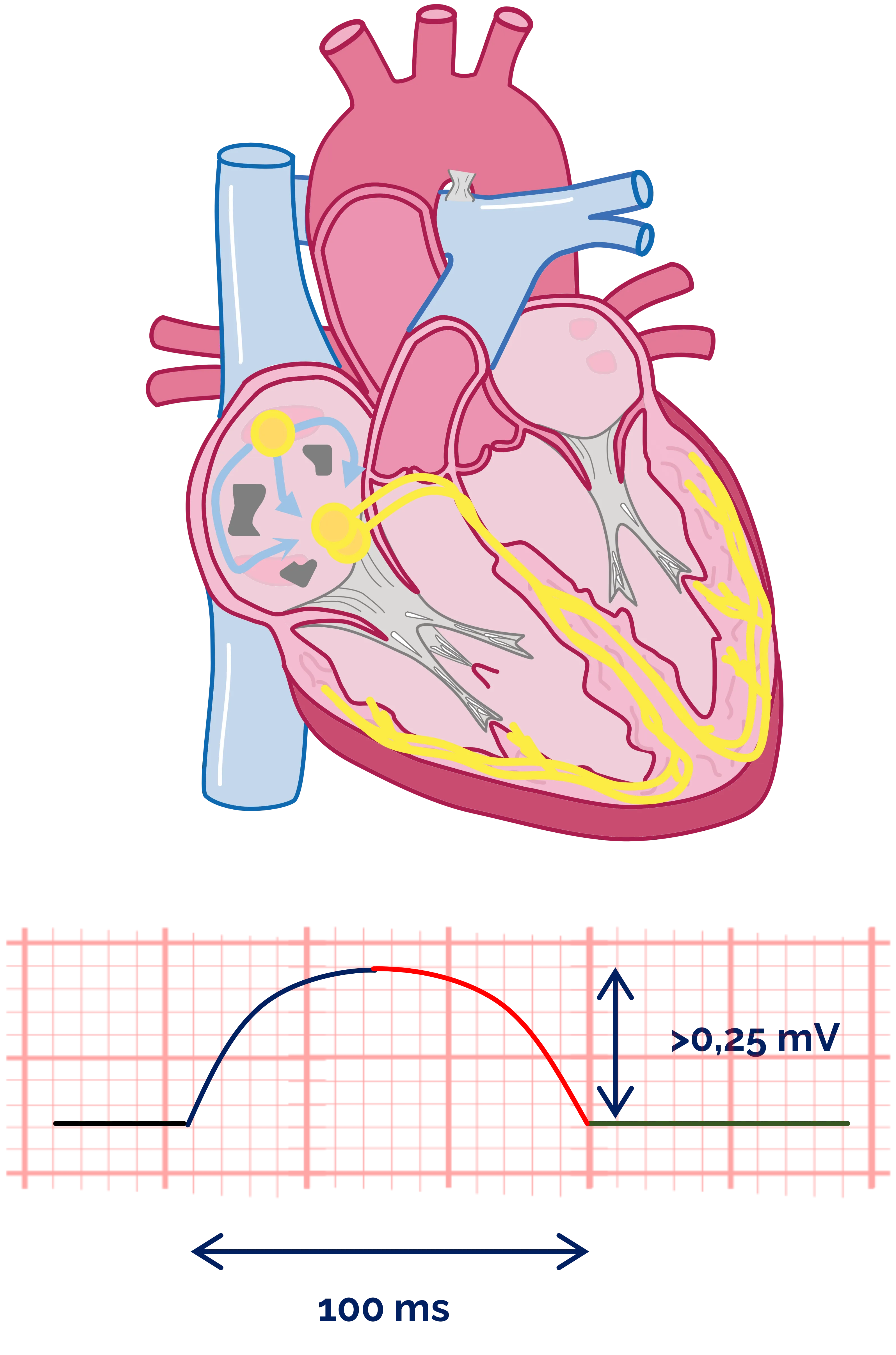P-dextroatriale/ P-pulmonale