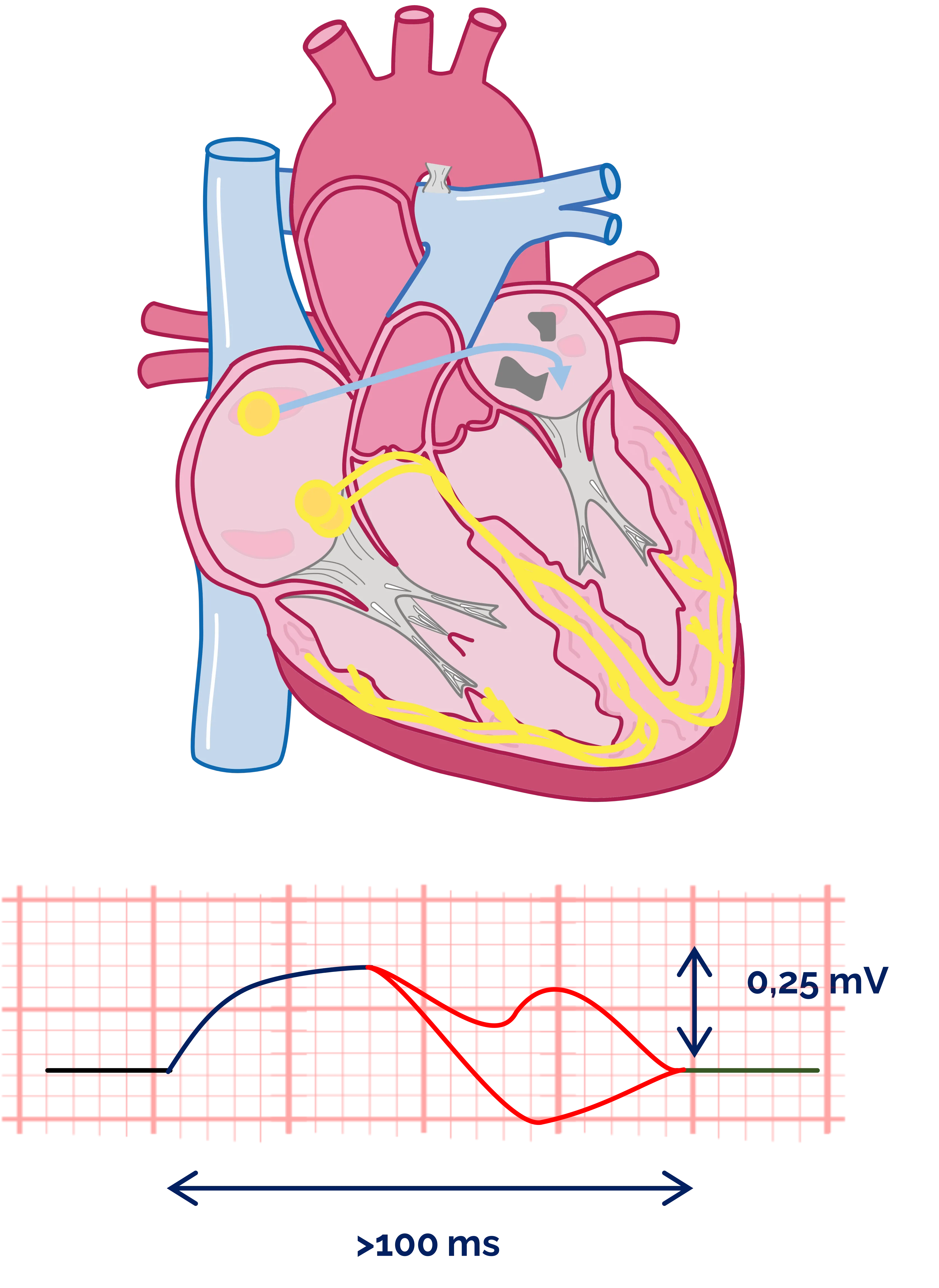 P-sinistroatriale/ P-mitrale