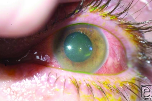 Alkalische Verätzung des Auges