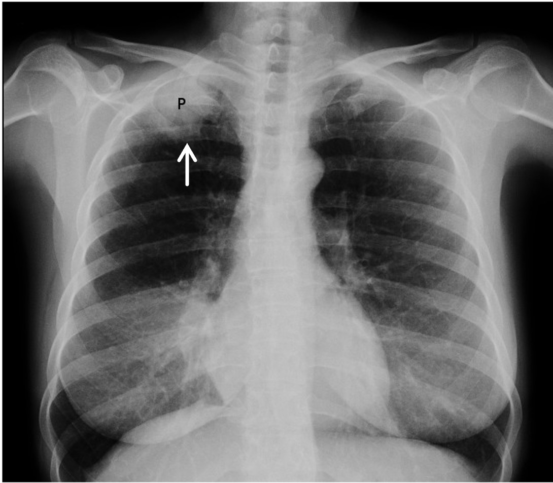 Pancoast-Tumor rechts im Röntgen-Thorax