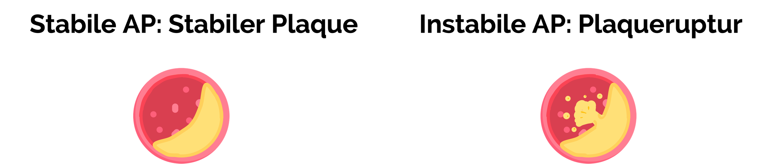 Pathophysiologie der Angina pectoris (AP)