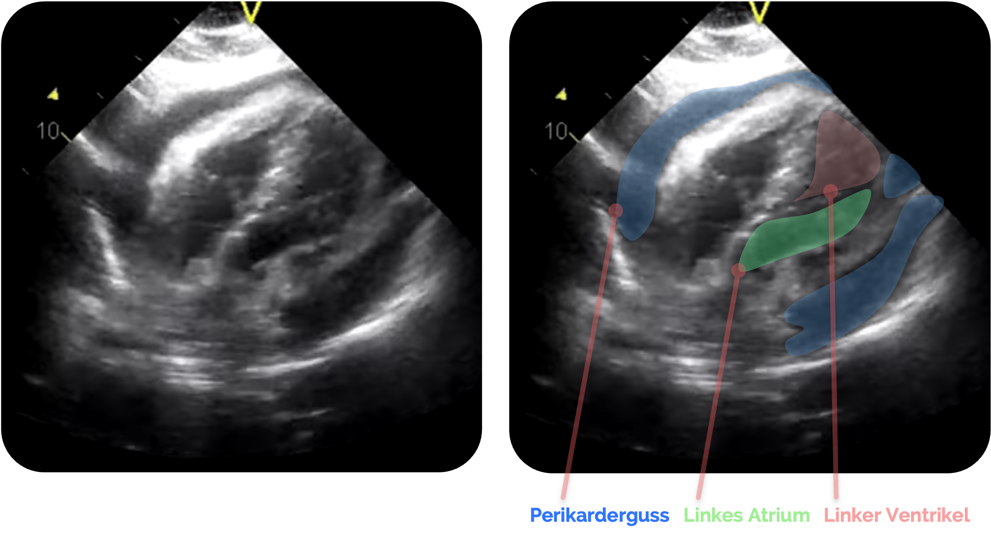 Darstellung eines Perikardergusses in der subxiphoidalen Ansicht