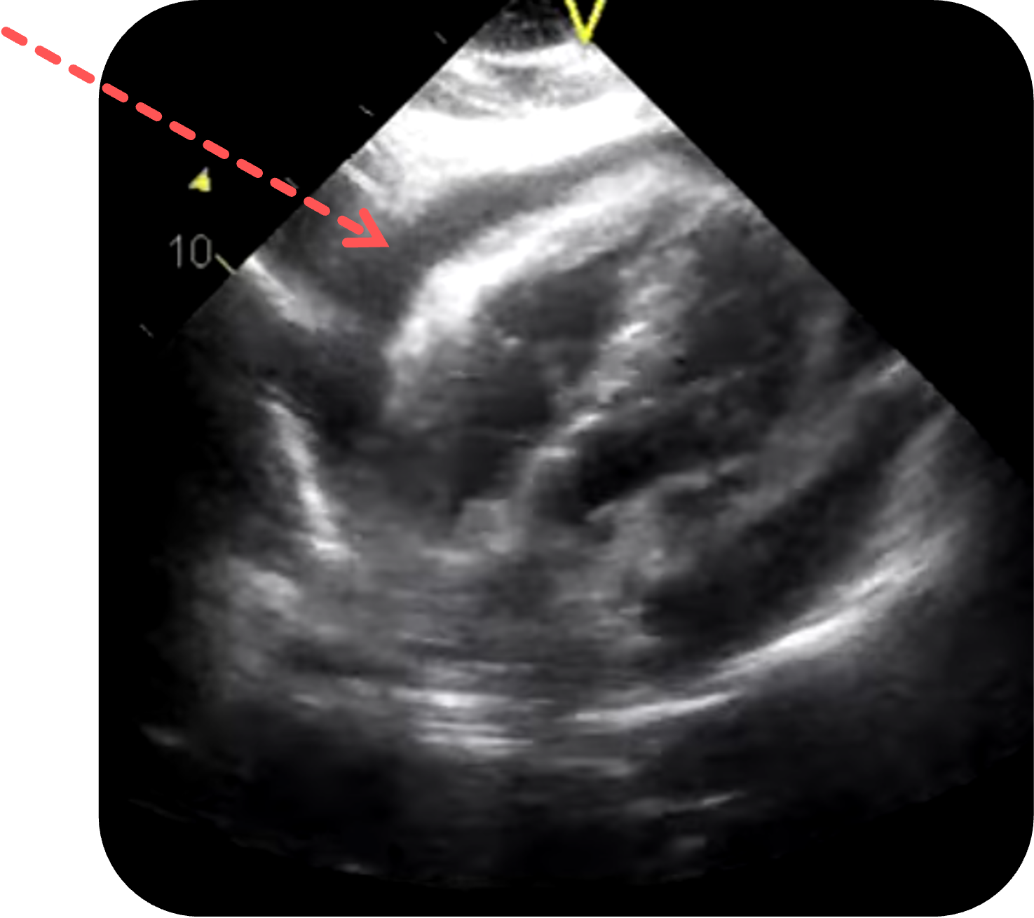 Darstellung eines Perikardergusses in der subxiphoidalen Ansicht