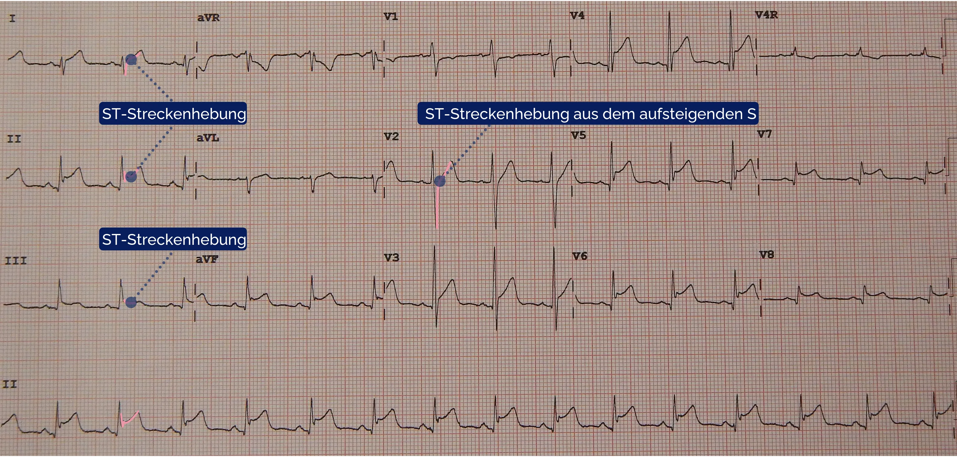 EKG-Fallbeispiel: Perikarditis