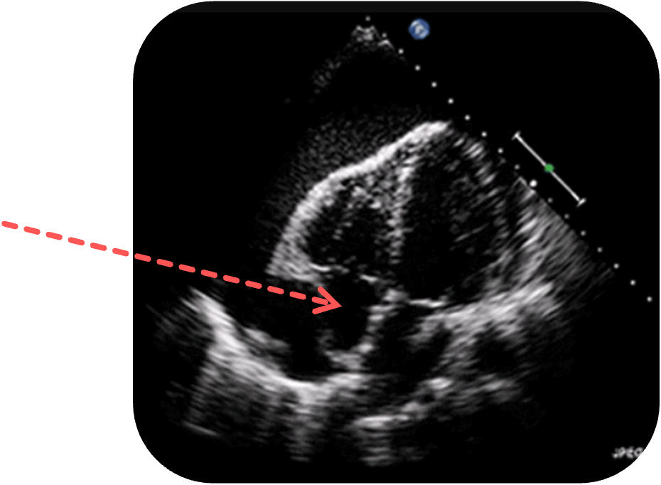 Darstellung einer Perikardtamponade, kollaptischer rechter Vorhof