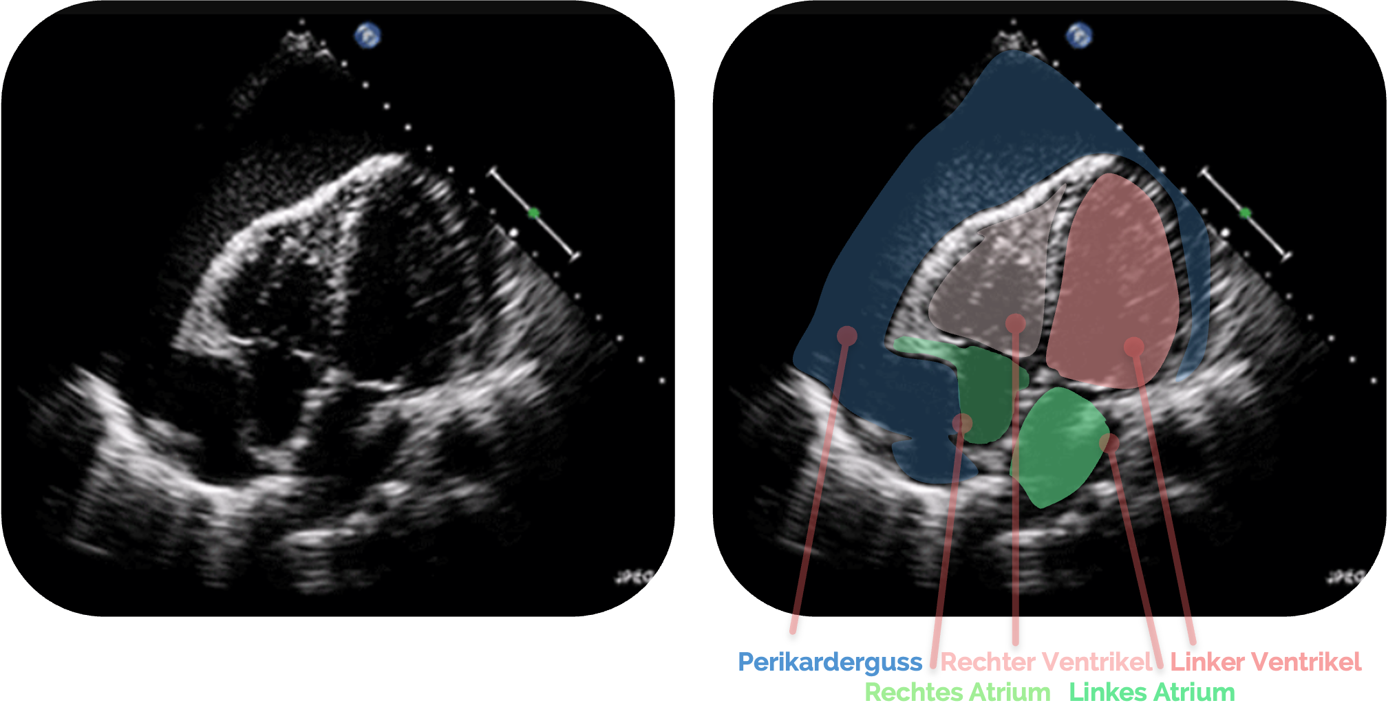 Darstellung einer Perikardtamponade, kollaptischer rechter Vorhof
