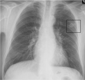 Peripheres Bronchial-Karzinom im Röntgen-Thorax