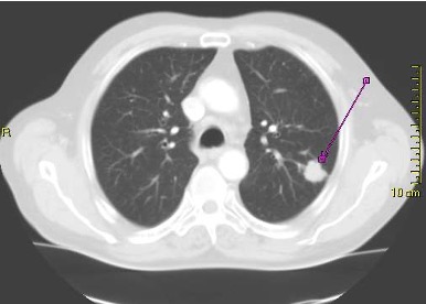CT-Aufnahme eines peripheren Bronchialkarzinoms