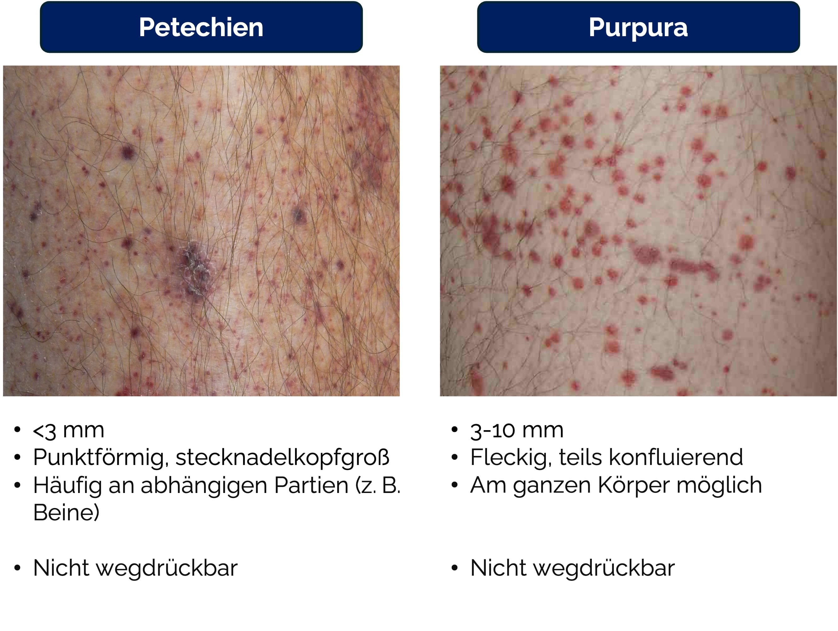 Petechien und Purpura