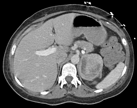 CT eines Phäochromozytoms