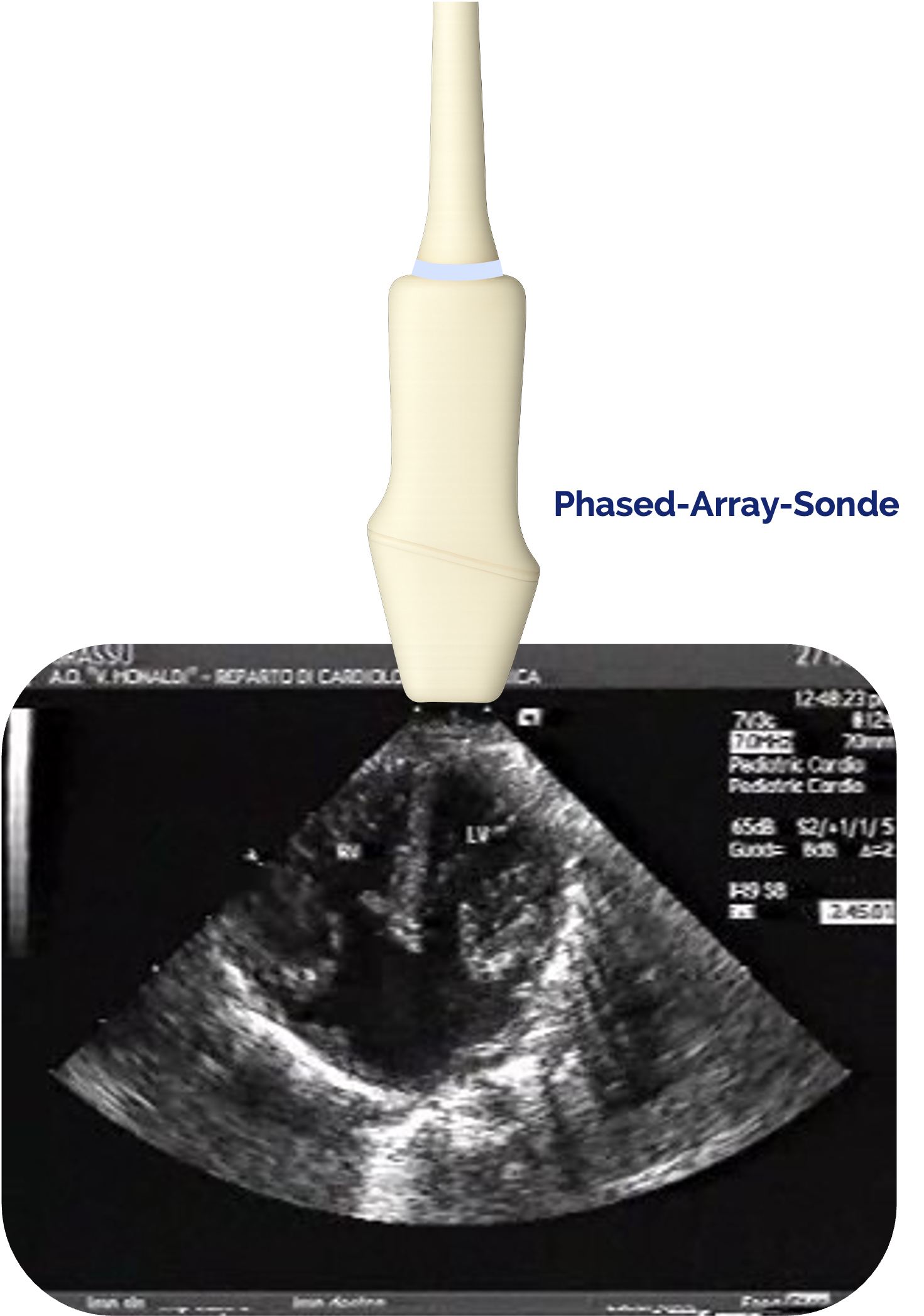 Phased-Array-Sonde - Darstellung eines atrioventrikulären Septumdefektes