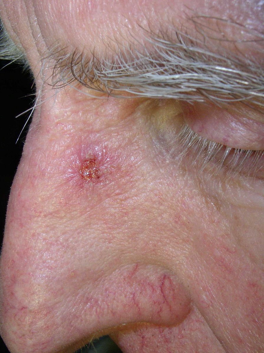 Plattenepithelkarzinom der Nase