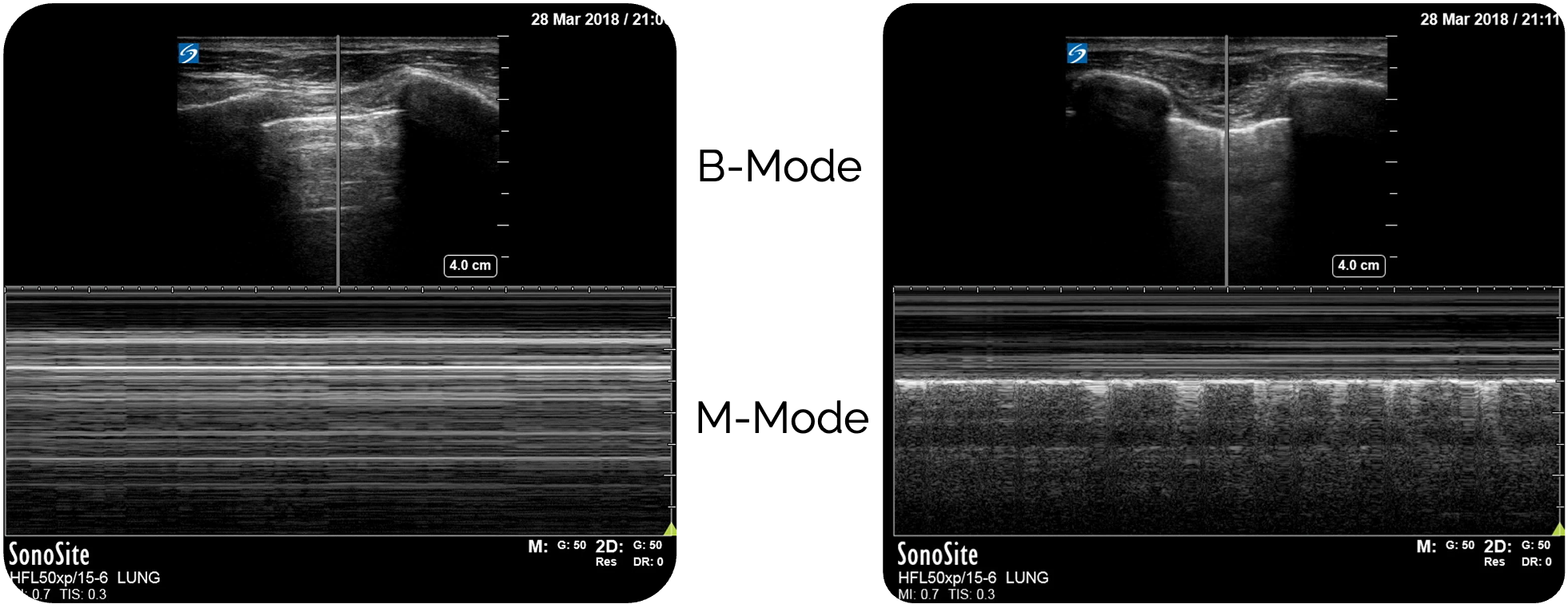Links Pneumothorax - Rechts: Normalbefund