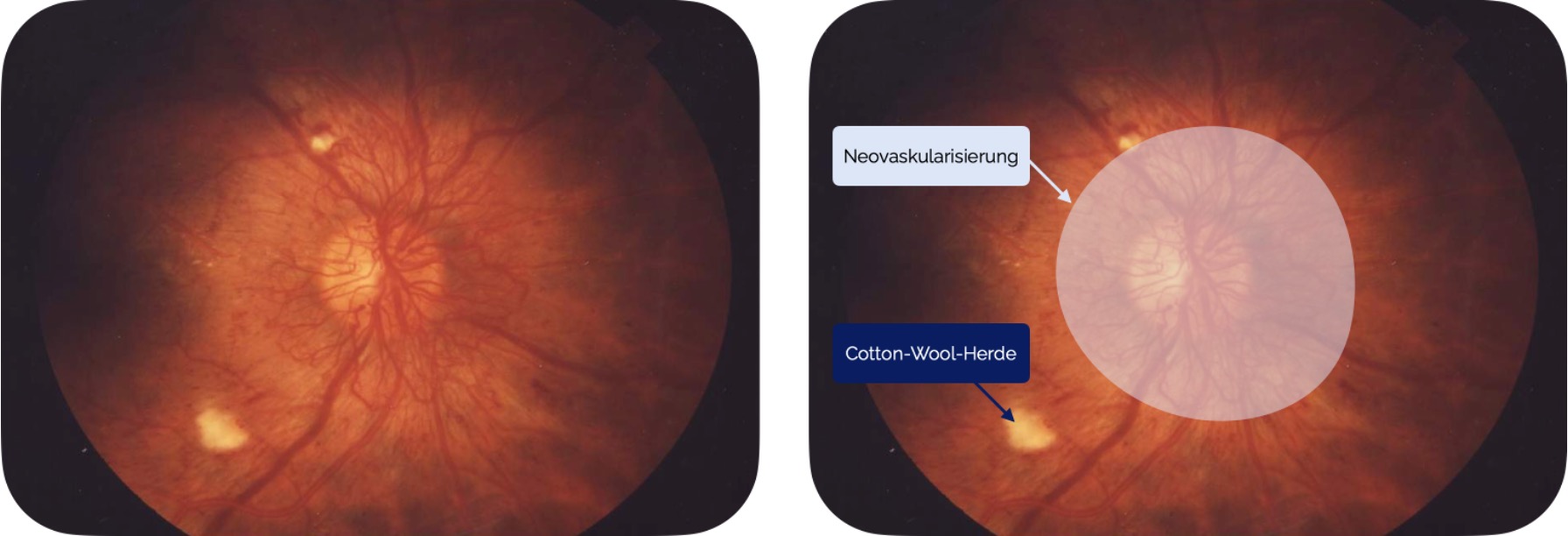 Proliferative diabetische Retinopathie