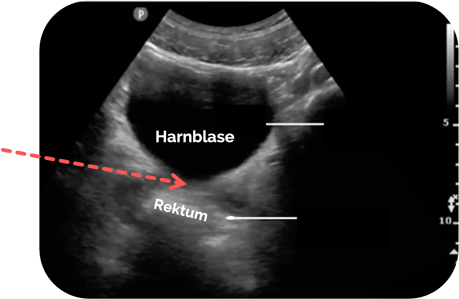 Normalbefund beim Mann