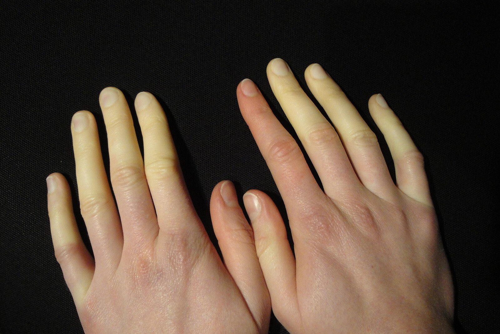 Raynaud-Syndrom der Finger