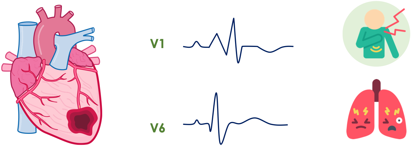 STEMI-Äquivalent: Rechtsschenkelblock