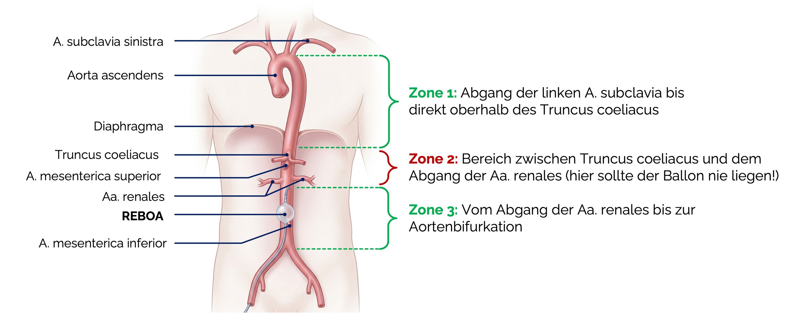 Anatomische Orientierung zur sicheren REBOA-Anwendung
