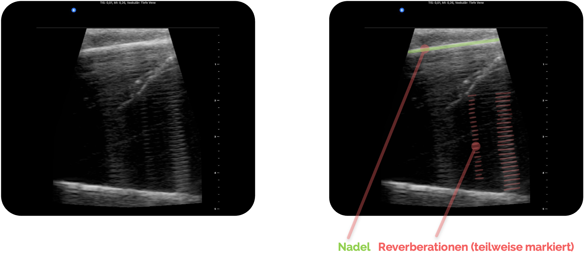 Sonographie: Reverberationen