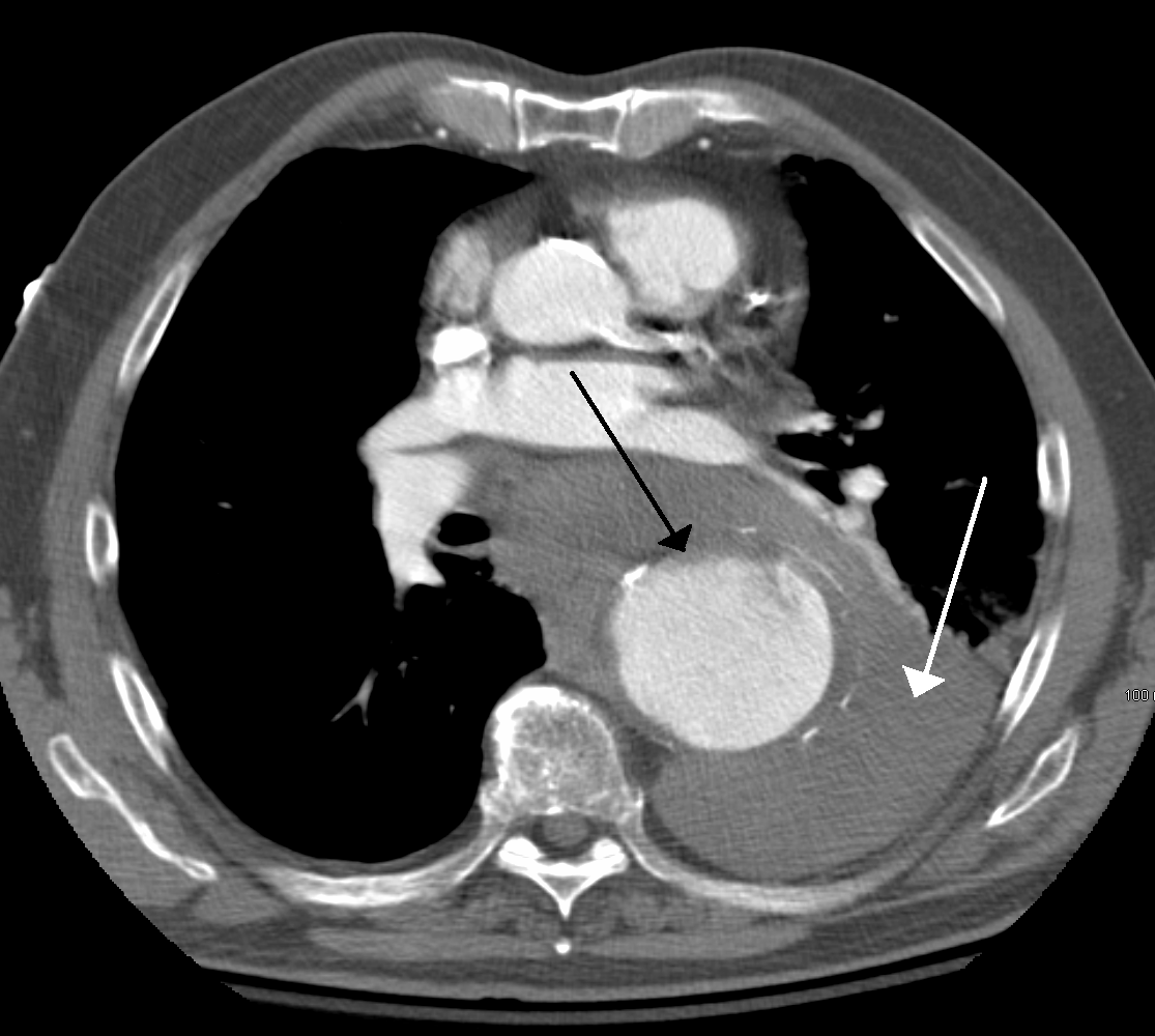 CT-Angiographie: rupturiertes thorakales Aortenaneurysma