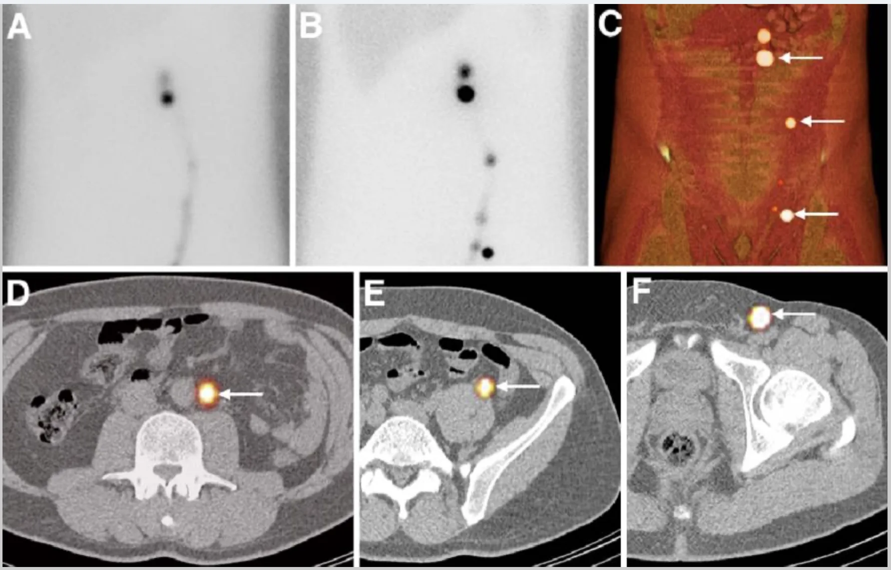 SPECT/CT Hodenkarzinom