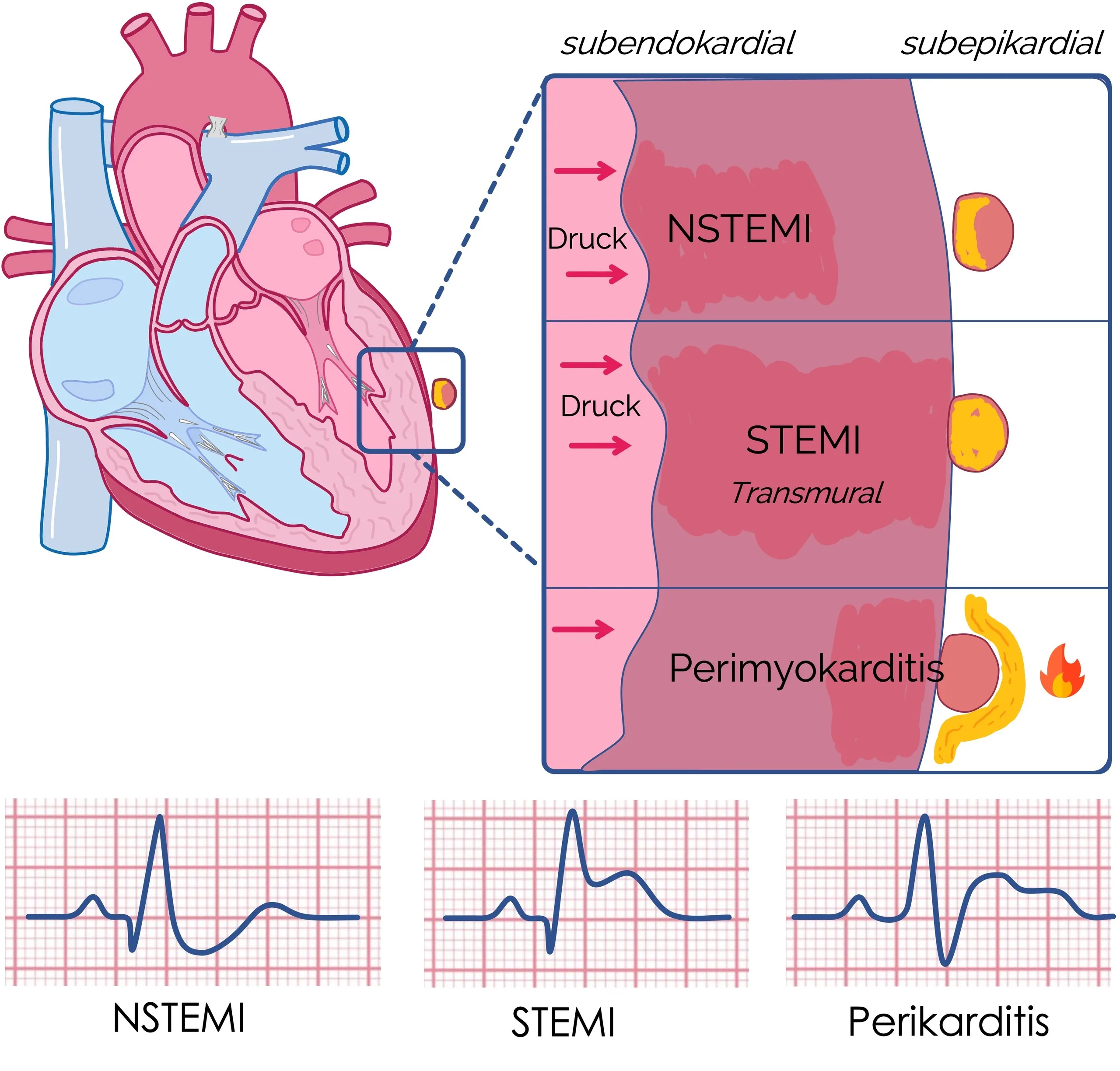 Vergleich NSTEMI, STEMI und Perikarditis