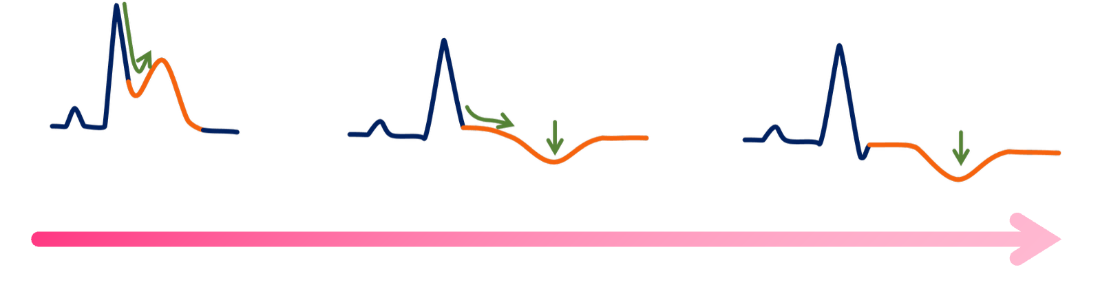 STEMI – Folgestadium