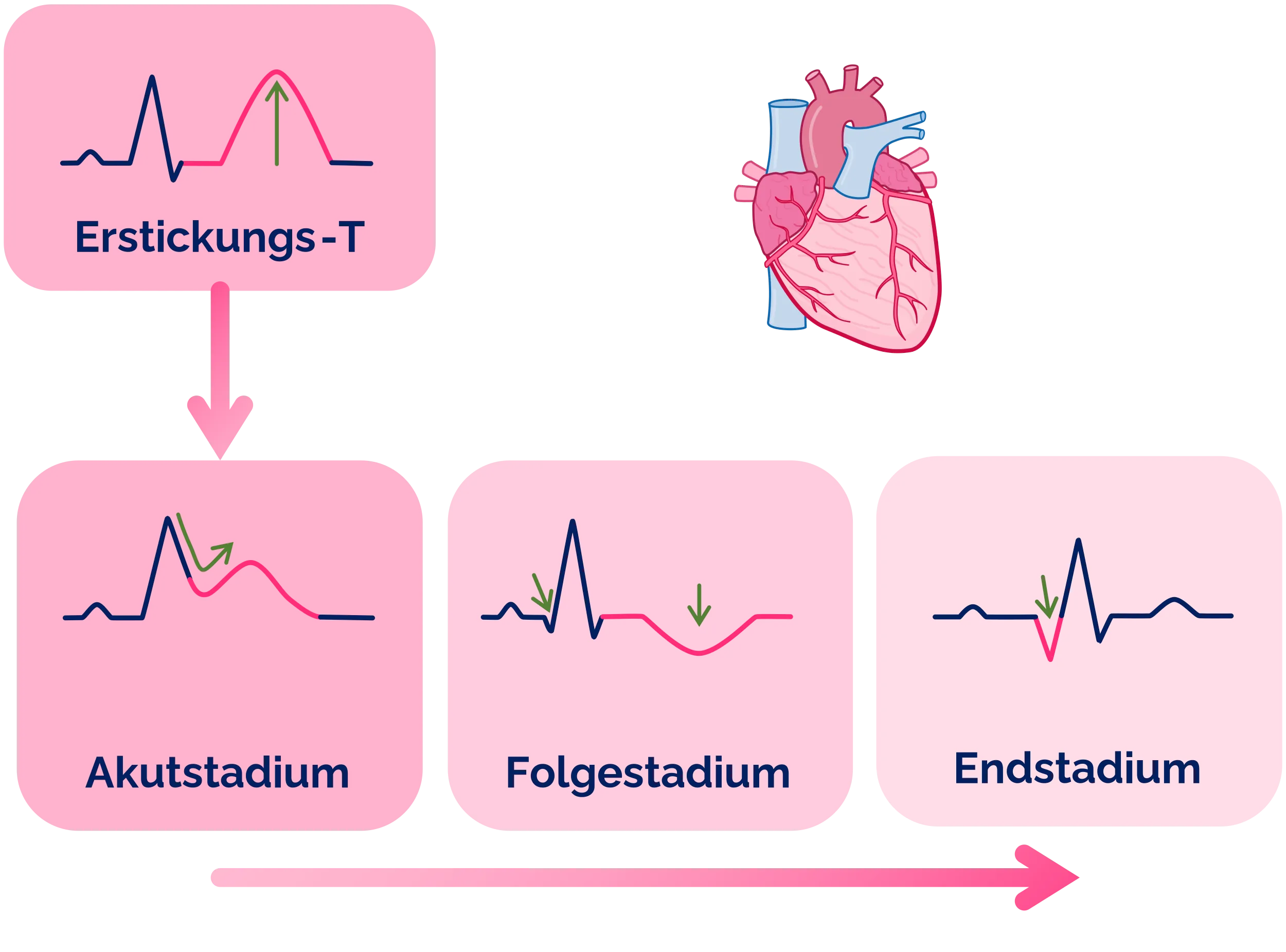 STEMI - Stadien