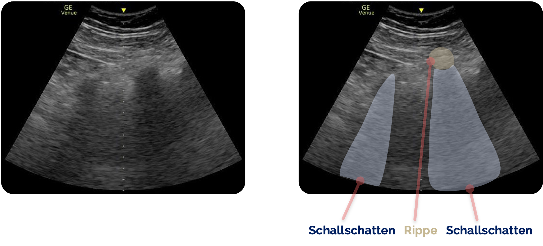 Schallschatten der Rippen links und rechts der Bildmitte