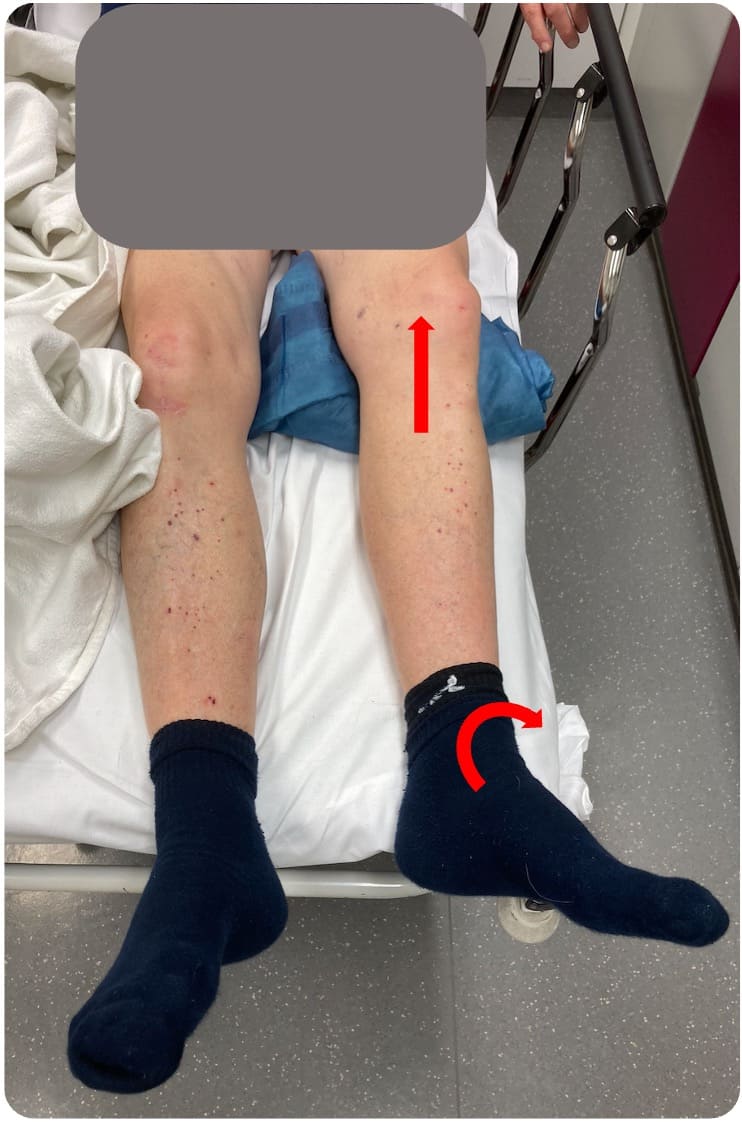 Klinische Präsentation einer Schenkelhalsfraktur links