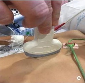 Sondenpositionierung zur Darstellung der Pleura