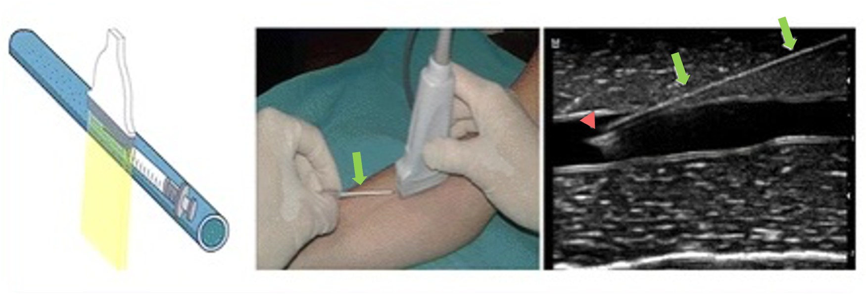 Sonographische Gefäßpunktion mittels der In-Plane-Technik