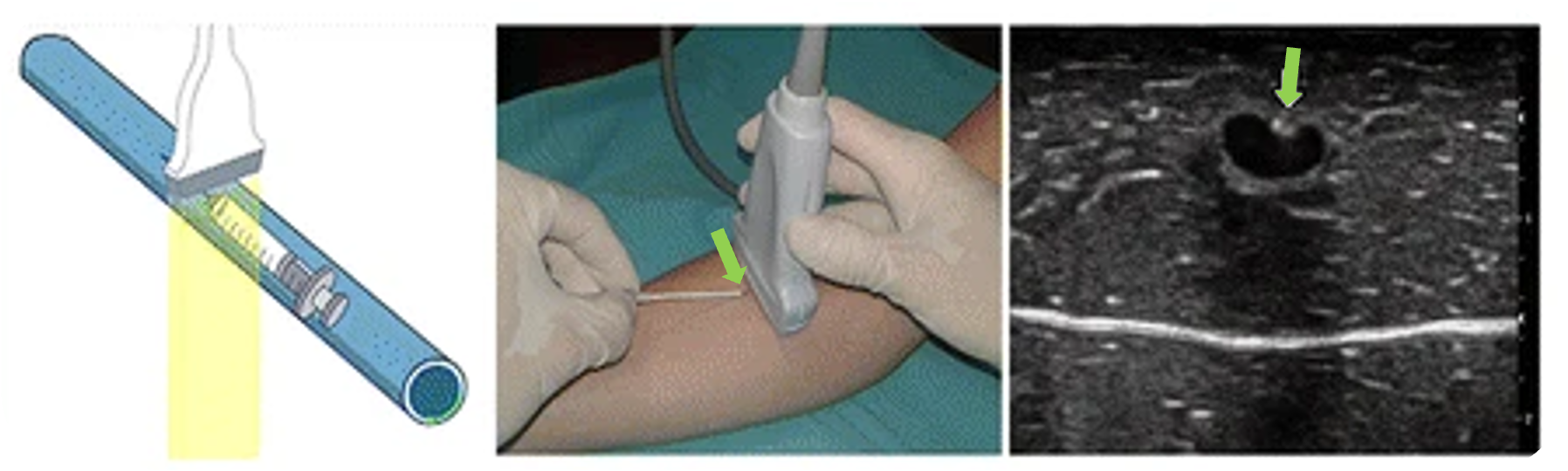 Sonographische Gefäßpunktion mittels der Out-of-Plane-Technik