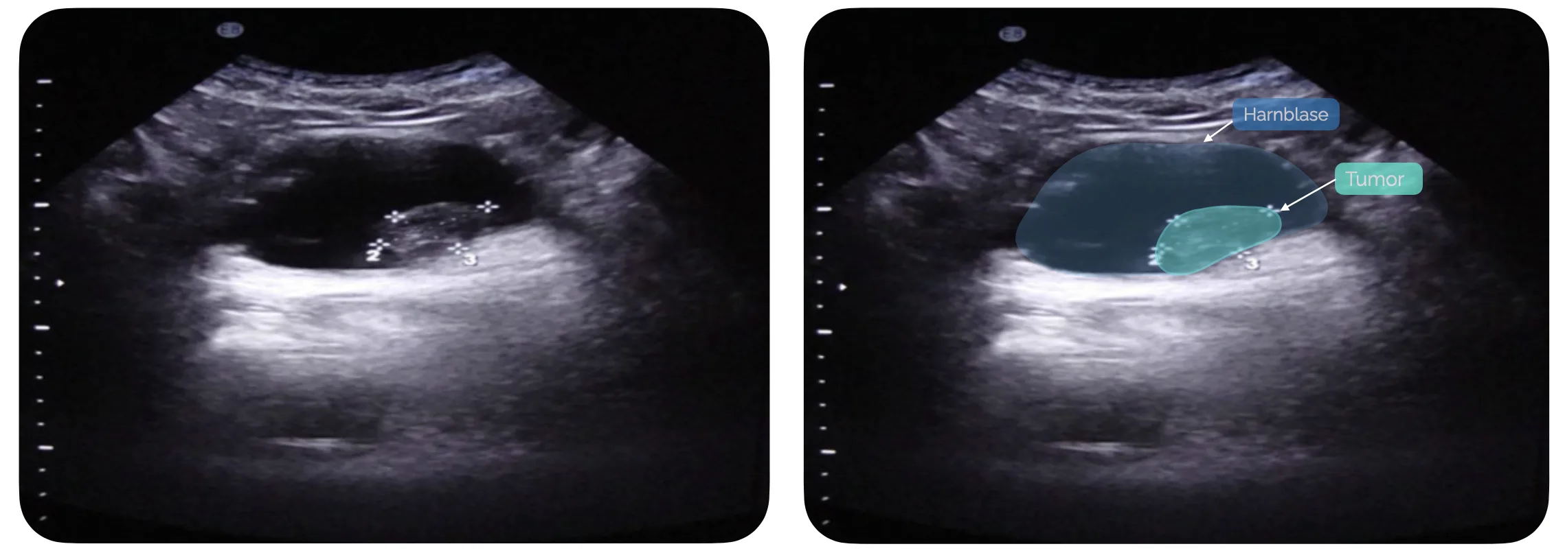 Sonografie Harnblasentumor