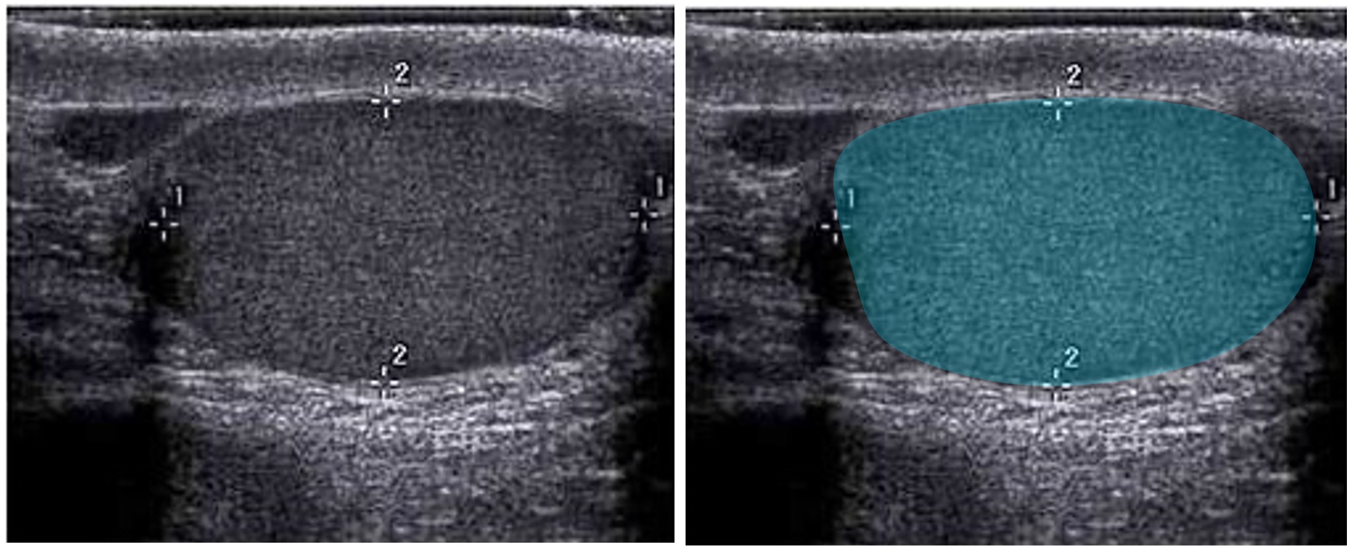 Sonografie des Hodens (Normalbefund)