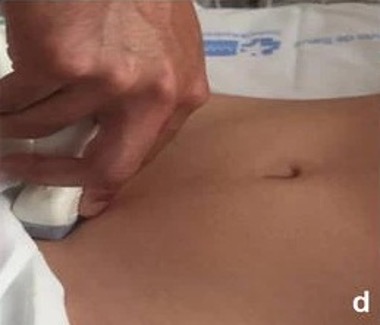 Sondenpositionierung zur Darstellung des Douglas-Raums