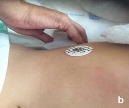 Sondenpositionierung zur Darstellung des Morrison-Pouch