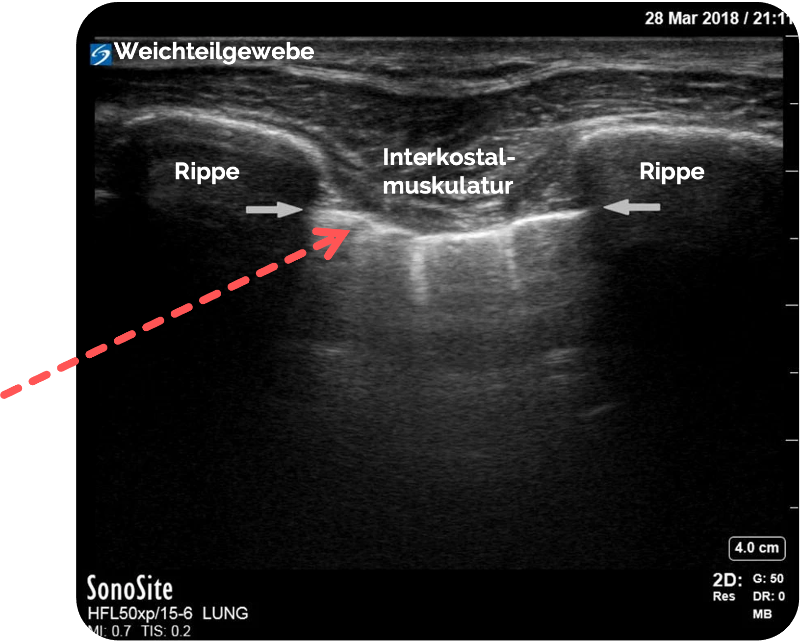Sonographische Darstellung der Pleura