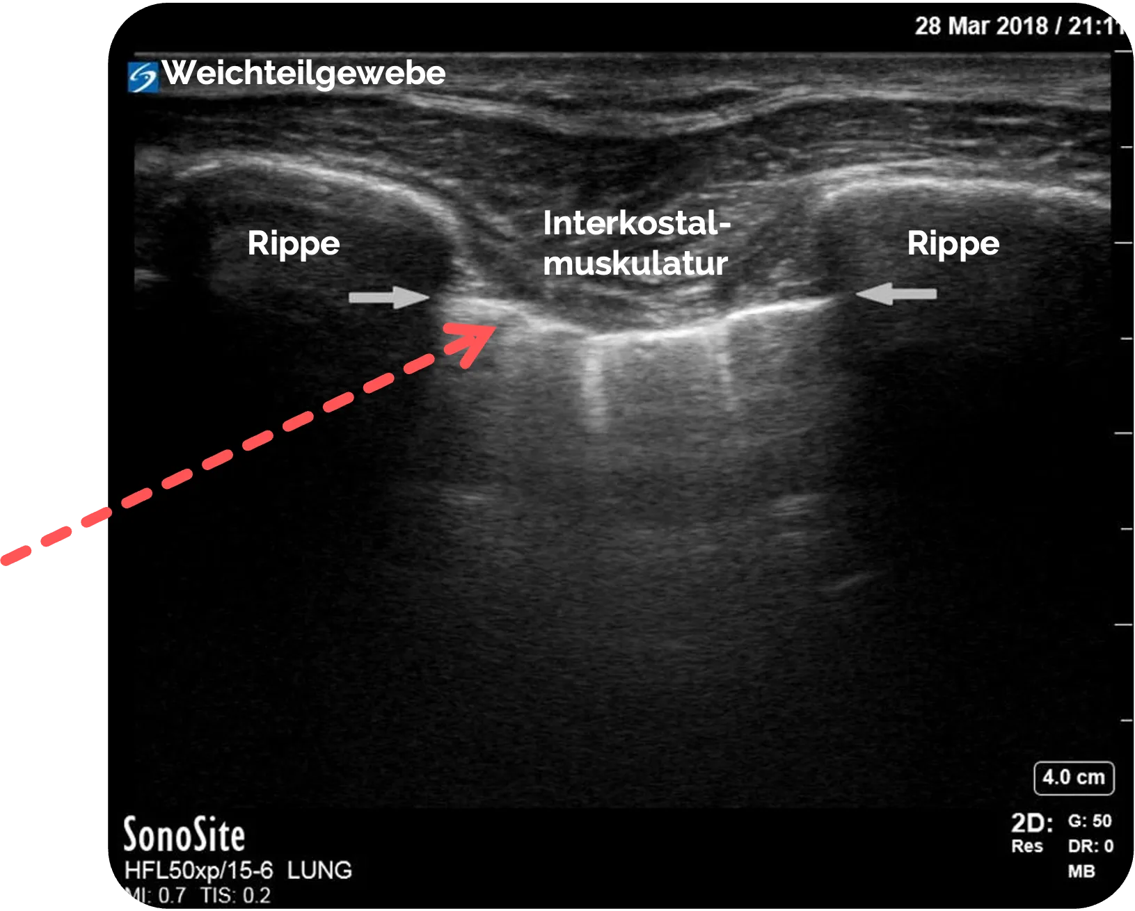 Sonographische Darstellung der Pleura