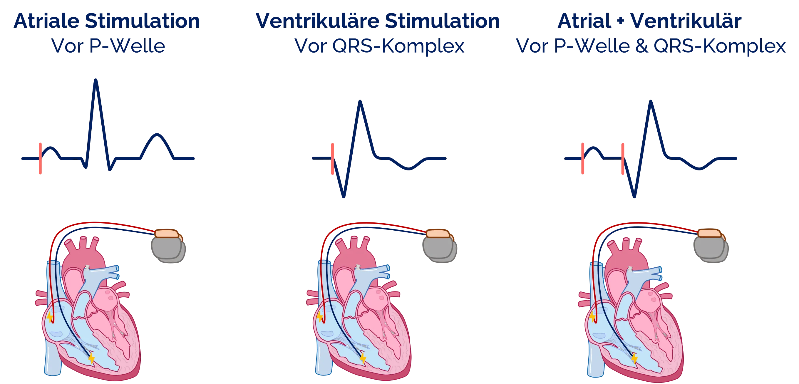 Stimulationsorte der Schrittmachersonden im EKG erkennen