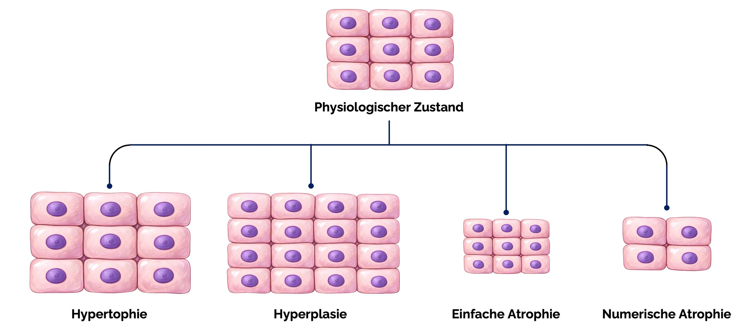 Störungen des Zellwachstums: Hypertrophie, Hyperplasie und Atrophie