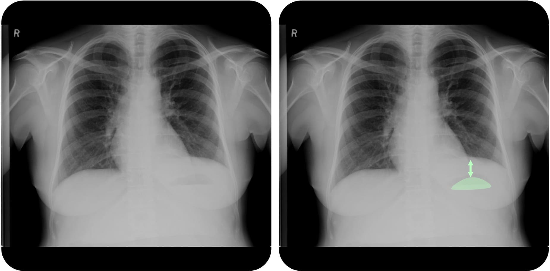 Subpulmonaler Erguss